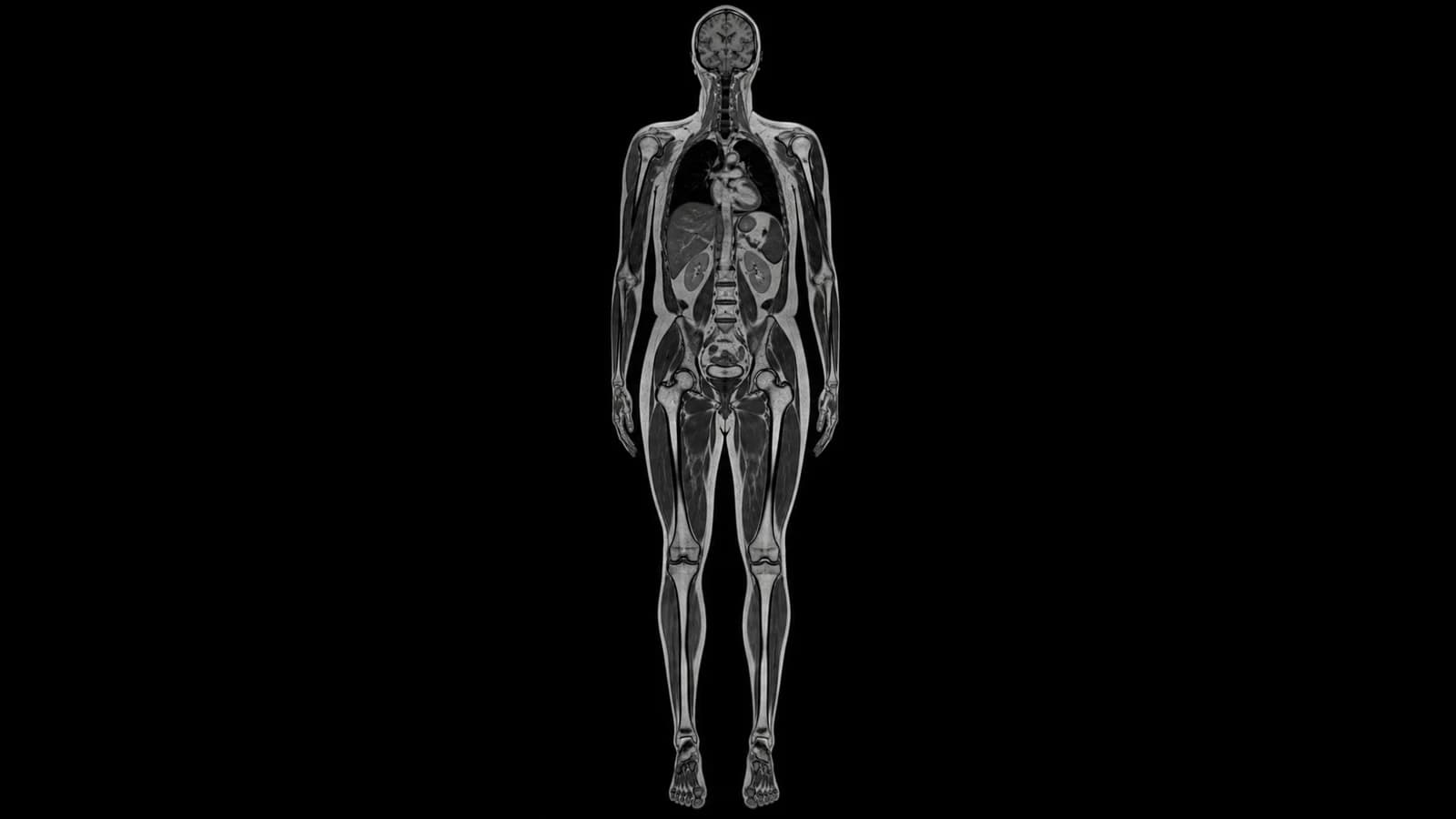 Whole-body MRI image